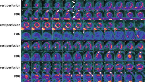 lv myocardial perfusion|abnormal sestamibi myocardial perfusion.